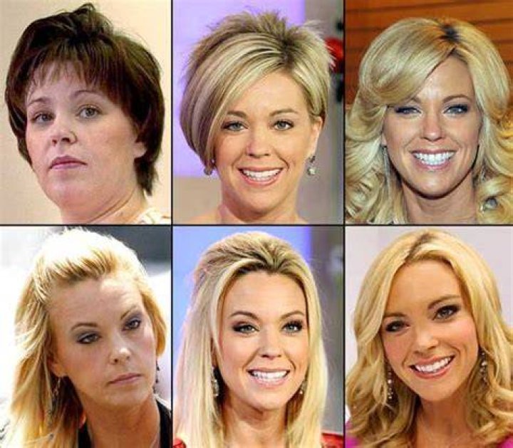 Kate Gosselin Plastic Surgery Obsession - Proof Of Botox And Neck Lift