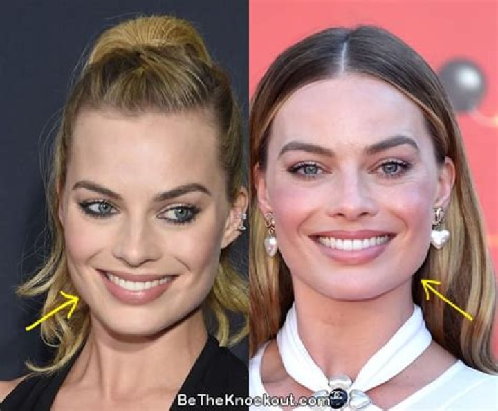 Margot Robbie Botox